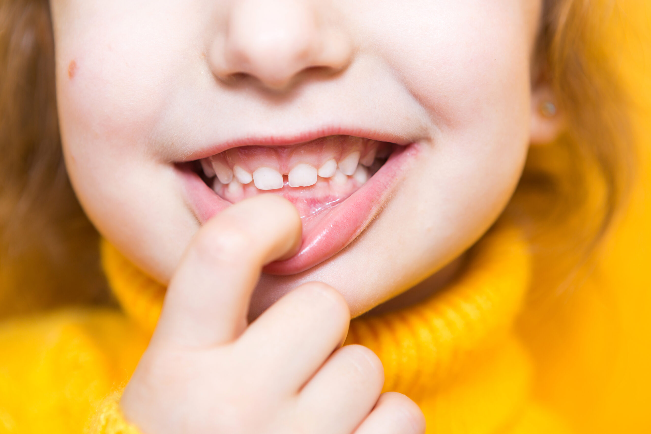 Girl shows her teeth-pathological bite, malocclusion, overbite. Girl shows her teeth-pathological bite, malocclusion, overbite. Pediatric dentistry and periodontics, bite correction. Health and care of teeth, caries treatment, baby teeth. Upper jaw rests on gum.